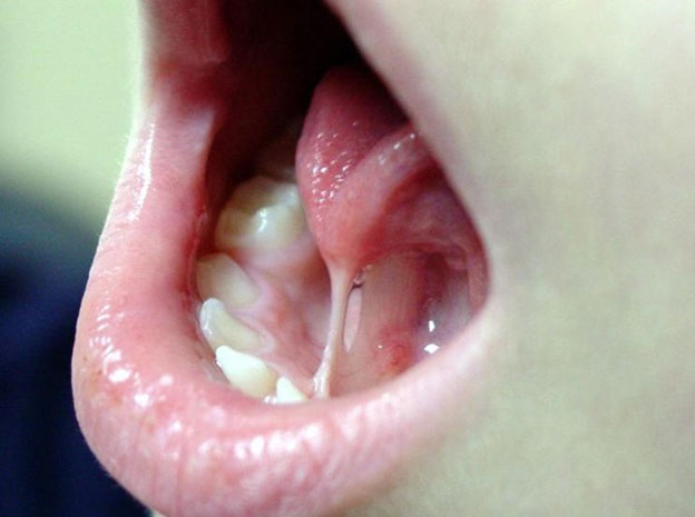 An Ankyloglossia or “Tongue-Tied” patient involving the Lingual Frenum