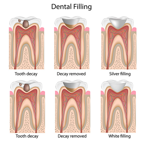 Natural & Tooth-Colored Dental Fillings Rio Rancho