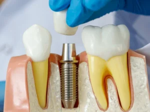 Dental Implants Gainesville